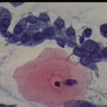 Ομάδα κυττάρων ενδοτραχήλου.